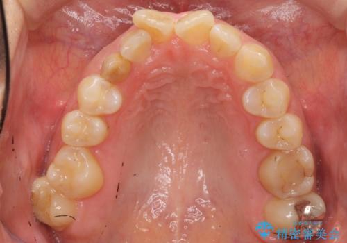 30代女性　残った乳歯を抜いてスペースを閉じる矯正　前歯のねじれの治療前