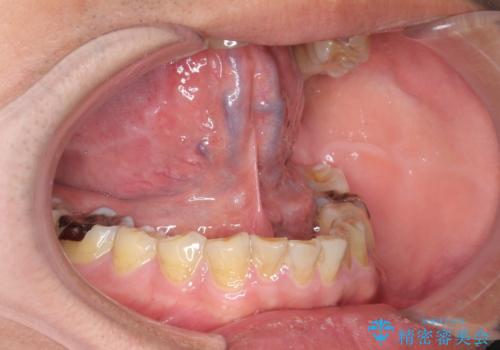 [日帰り手術] 舌小帯切除　滑舌をよくしたいの症例 治療前