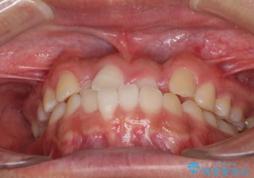 美容歯科でも断られた　著しい前歯のクロスバイトをワイヤー矯正で改善の治療前