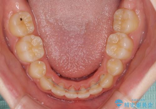 乳歯が残っている　目立たない装置での抜歯矯正の治療後