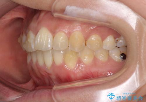 インビザラインによる狭窄歯列の拡大矯正　の治療中