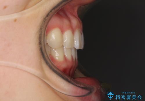 インビザラインによるすきっ歯の改善の治療後