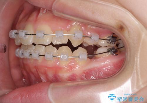 乳歯が残っている　目立たない装置での抜歯矯正の治療中
