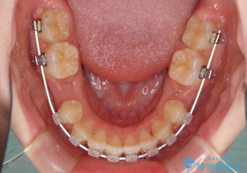 乳歯が残っている　目立たない装置での抜歯矯正の治療中