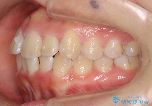 上下の前歯のがたつき　歯を抜かずに矯正の治療中