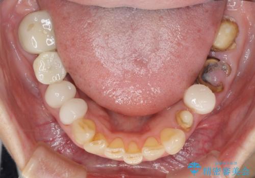 歯の欠損を放置　オールセラミックブリッジによる補綴治療の治療前