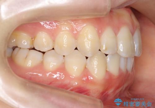 上下の前歯のがたつき　歯を抜かずに矯正の治療後