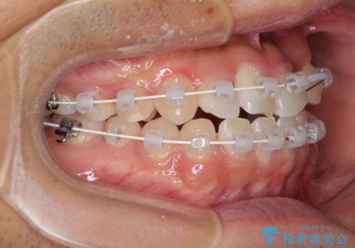 美容歯科でも断られた　著しい前歯のクロスバイトをワイヤー矯正で改善の治療中