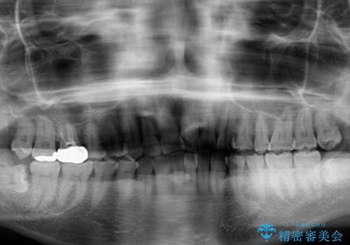 インビザラインによる狭窄歯列の拡大矯正　の治療前