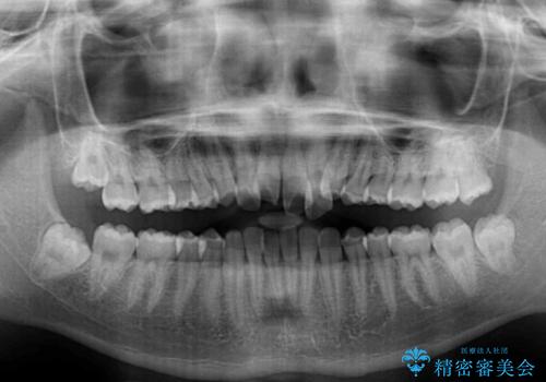 美容歯科でも断られた　著しい前歯のクロスバイトをワイヤー矯正で改善の治療前