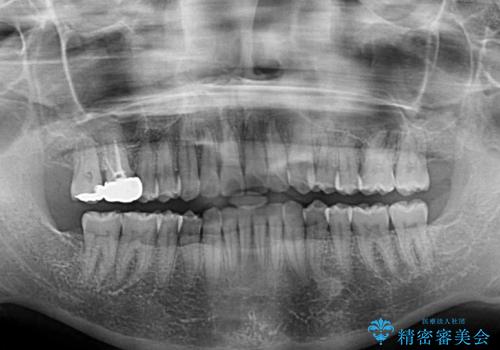インビザラインによる狭窄歯列の拡大矯正　の治療後