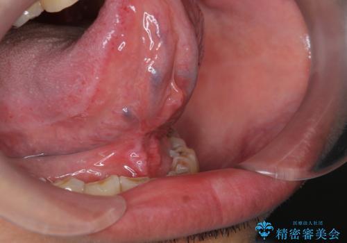 [日帰り手術] 舌小帯切除　滑舌をよくしたいの症例 治療後