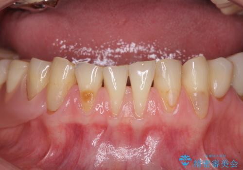 前歯の歯肉退縮　歯肉移植による根面被覆の症例 治療前