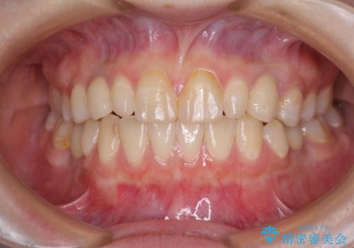 欠損と残存乳歯　矯正治療とインプラント治療の症例 治療後