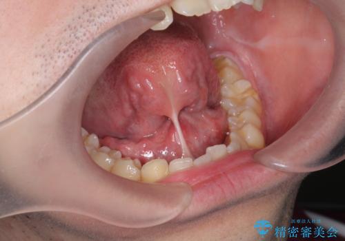 滑舌の改善　舌小帯の形成の症例 治療前
