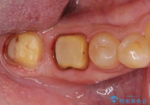 骨の中にまで及んだ深い虫歯　歯周外科処置を用いた補綴治療の治療中