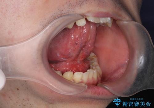 滑舌の改善　舌小帯の形成の症例 治療後
