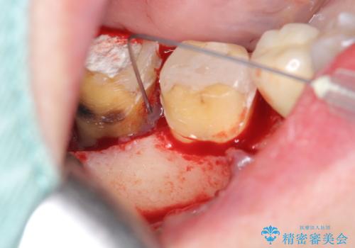 [歯周病再生治療]  根尖に至る骨欠損の改善の治療前