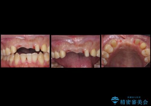 前歯ブリッジのやりかえ　下の歯のがたつき　銀歯を全てセラミックにの治療中