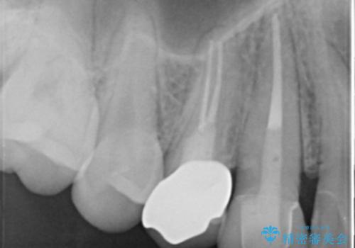 虫歯で歯が折れた セラミック審美修復の治療後