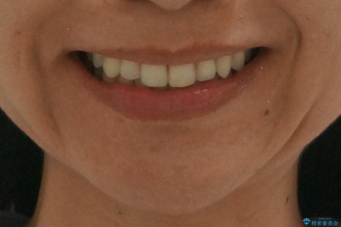 埋まっている奥歯を引っ張り出す　インビザライン矯正の治療後（顔貌）