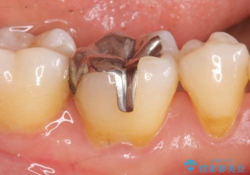 オールセラミッククラウン　目立つ銀歯を白い歯への治療前