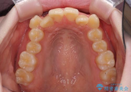 前歯をきれいに整えたい　ワイヤー装置での非抜歯矯正の治療前