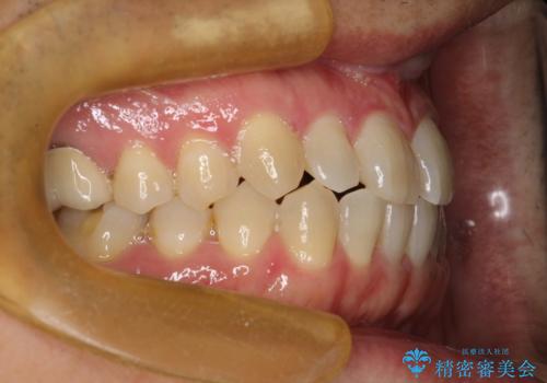前歯の隙間　インビザラインにて整った歯並びへの治療前