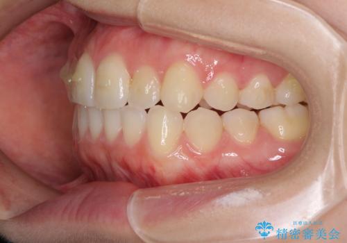 前歯のクロスバイトをインビザライン矯正で改善の治療中