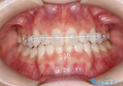前歯の後戻りを部分矯正で整った歯並びへの治療中