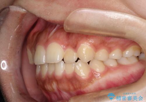 インビザライン　前歯のがたつきを目立たず矯正の治療前