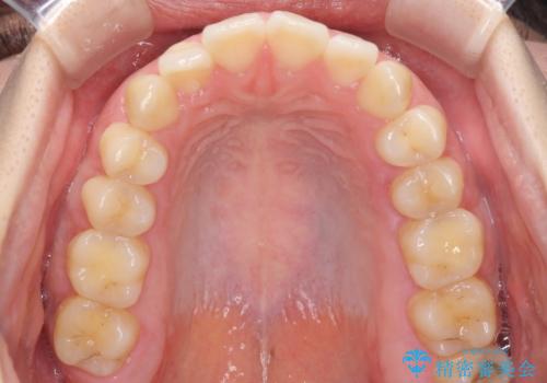 [口ゴボ] 口元が出ているのが気になる　ワイヤーによる抜歯矯正で口元をすっきりとの治療前