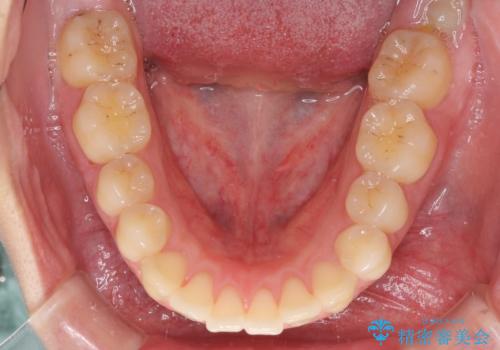 [口ゴボ] 口元が出ているのが気になる　ワイヤーによる抜歯矯正で口元をすっきりとの治療前