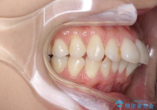 裏側のワイヤー矯正　抜歯して前歯をしっかり後ろに下げるの治療前