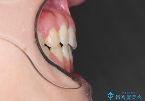 [口ゴボ] 口元が出ているのが気になる　ワイヤーによる抜歯矯正で口元をすっきりとの治療後