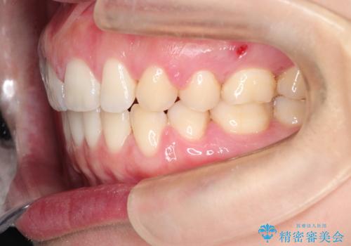[口ゴボ] 口元が出ているのが気になる　ワイヤーによる抜歯矯正で口元をすっきりとの治療後