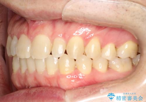 前歯の隙間　インビザラインにて整った歯並びへの治療後