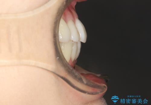 裏側のワイヤー矯正　抜歯して前歯をしっかり後ろに下げるの治療後