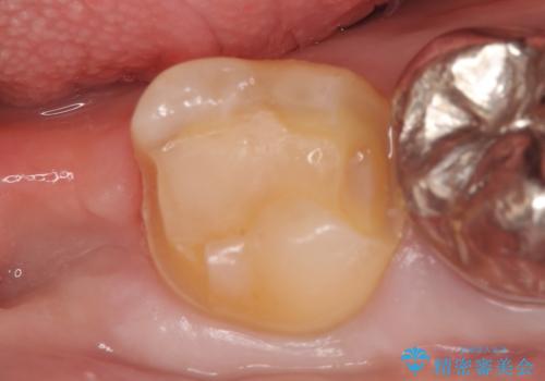 PGA(ゴールド)インレー　しみる銀歯の虫歯治療の治療中