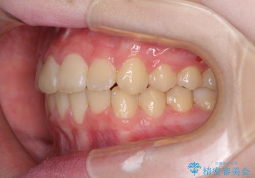 前歯をきれいに整えたい　ワイヤー装置での非抜歯矯正の治療後
