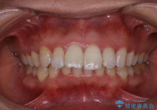 歯を白くしたい‐ウォーキングブリーチで内側から白くの治療後