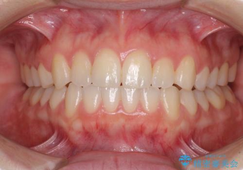 前歯のクロスバイトをインビザライン矯正で改善の治療後