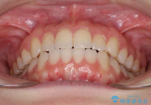 前歯のクロスバイトをインビザライン矯正で改善の治療後