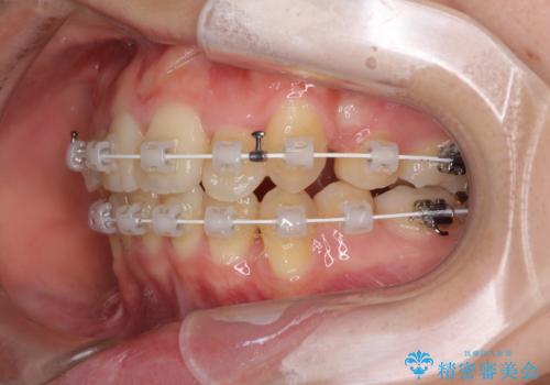 気になる八重歯を治したい　ワイヤー装置での抜歯矯正の治療中