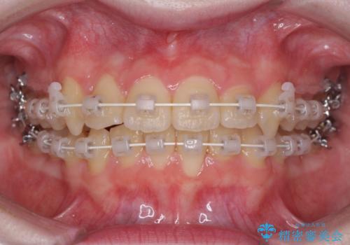 前歯をきれいに整えたい　ワイヤー装置での非抜歯矯正の治療中