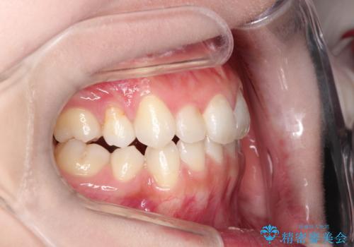 前歯の後戻りを部分矯正で整った歯並びへの治療前