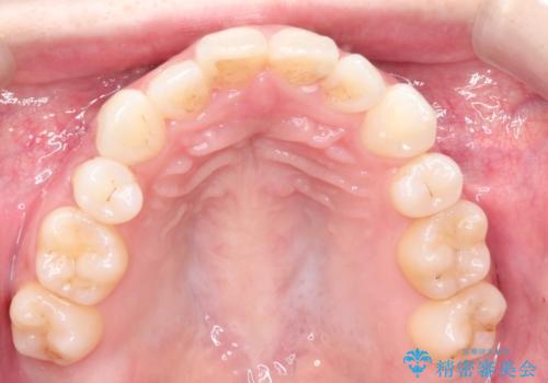前歯の後戻りを部分矯正で整った歯並びへの治療前