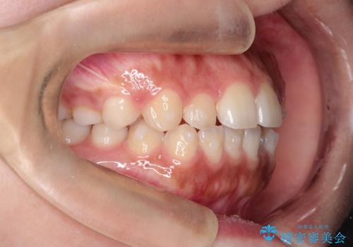 インビザライン　前歯のがたつきを目立たず矯正の治療中