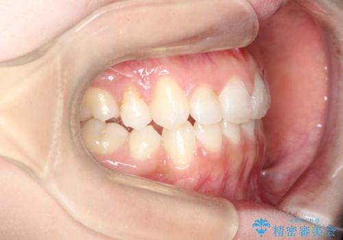 前歯の後戻りを部分矯正で整った歯並びへの治療後