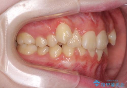 前歯をきれいに整えたい　ワイヤー装置での非抜歯矯正の治療前